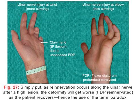 Ulnar Nerve Lesions: Causes and Treatments of Nerve .